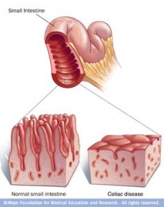 Celiac Villi